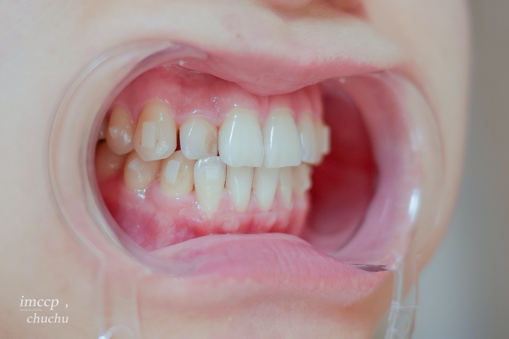 牙套日記#3 隱形牙套清潔重點/居家牙齒美白/0~6個月牙齒紀錄 @台灣矯正品牌SOV舒服美