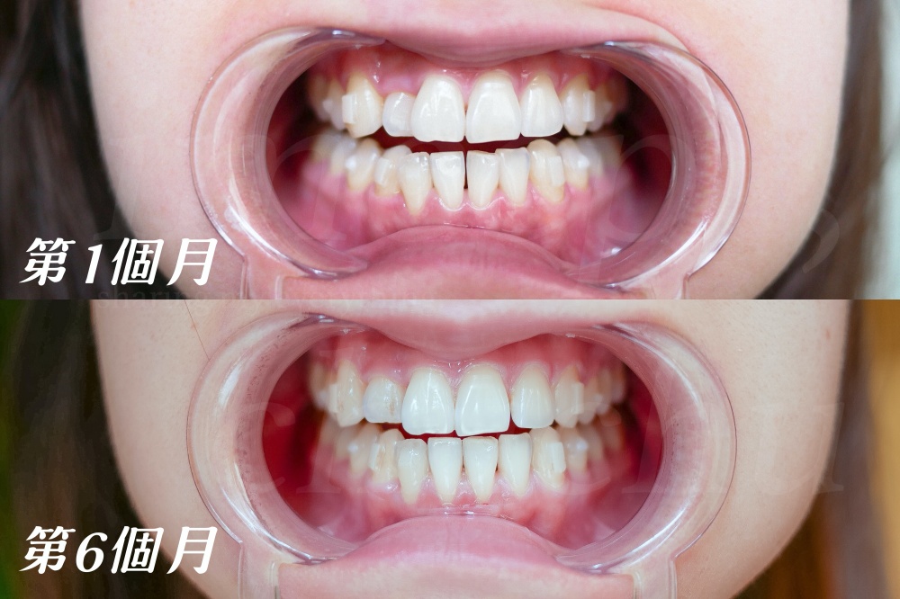 牙套日記#3 隱形牙套清潔重點/居家牙齒美白/0~6個月牙齒紀錄 @台灣矯正品牌SOV舒服美
